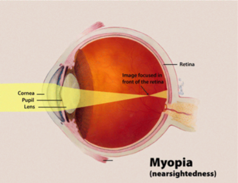 Myopia, Nearsightedness
